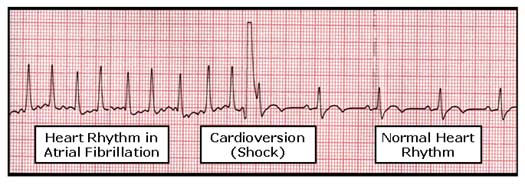 cardioversion for atrial fibrillation