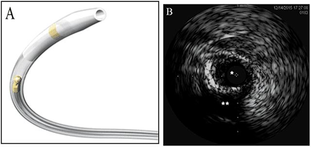 Boston Scientific Opticross IVUS